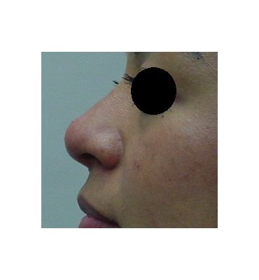 filler for rhinoplasty